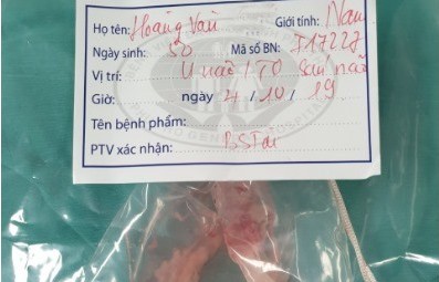 Người đàn ông bị suy giảm trí nhớ nhanh vì ổ sán cư trú trong não